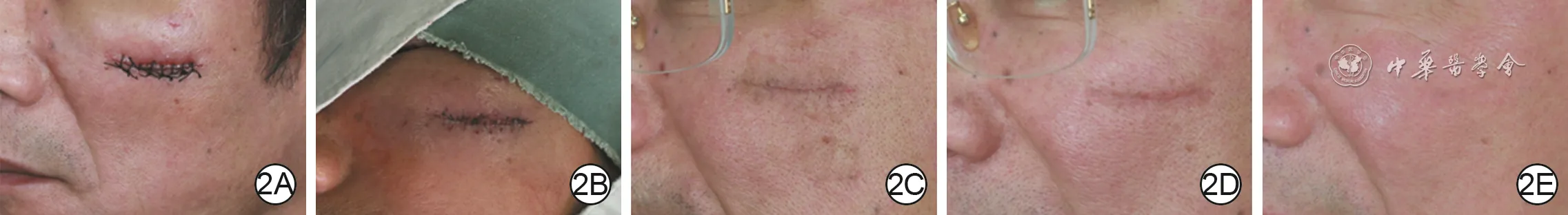 Serial follow-up of an adult left facial laceration after debridement, meticulous resuturing, and two ion-beam tissue-remodeling treatments