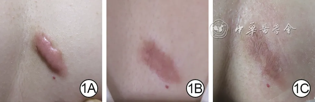 Chest keloid after folliculitis before and at one and two months after pulsed dye laser combined with triamcinolone injection