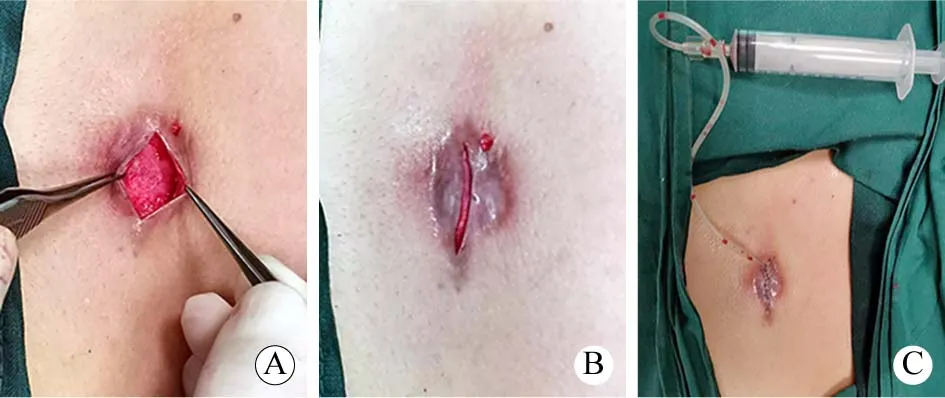 Operative sequence of chest-wall keloid core excision with preservation of scar flaps, layered closure, and negative-pressure drainage