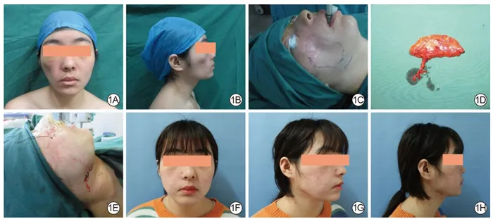 Preoperative, operative, and nine-month follow-up images of a right facial depressed scar reconstructed with a vascularized anterolateral thigh free fat flap