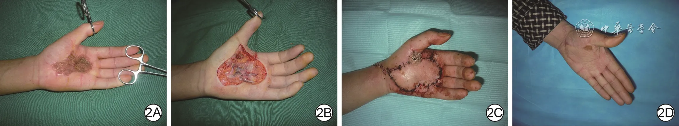 Preoperative, operative, and ten-month follow-up images of left palmar scar contracture after electrical burn treated by release and reconstruction with a left medial plantar free flap