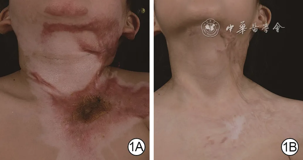 Early red hypertrophic burn scars of a child’s chin, neck, and anterior chest before and after combined laser treatment with multipoint microinjection of triamcinolone