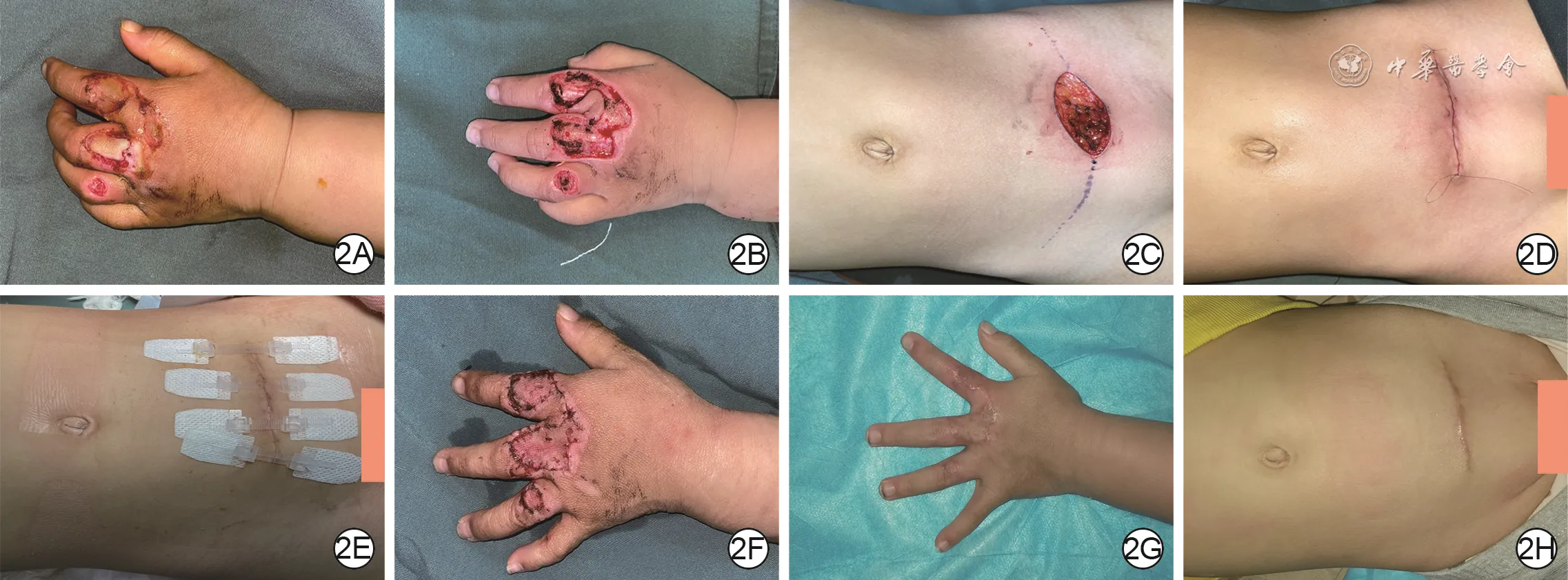 Preoperative, operative, and follow-up images of a pediatric dorsal hand wound repaired with a full-thickness skin graft from the lower abdomen
