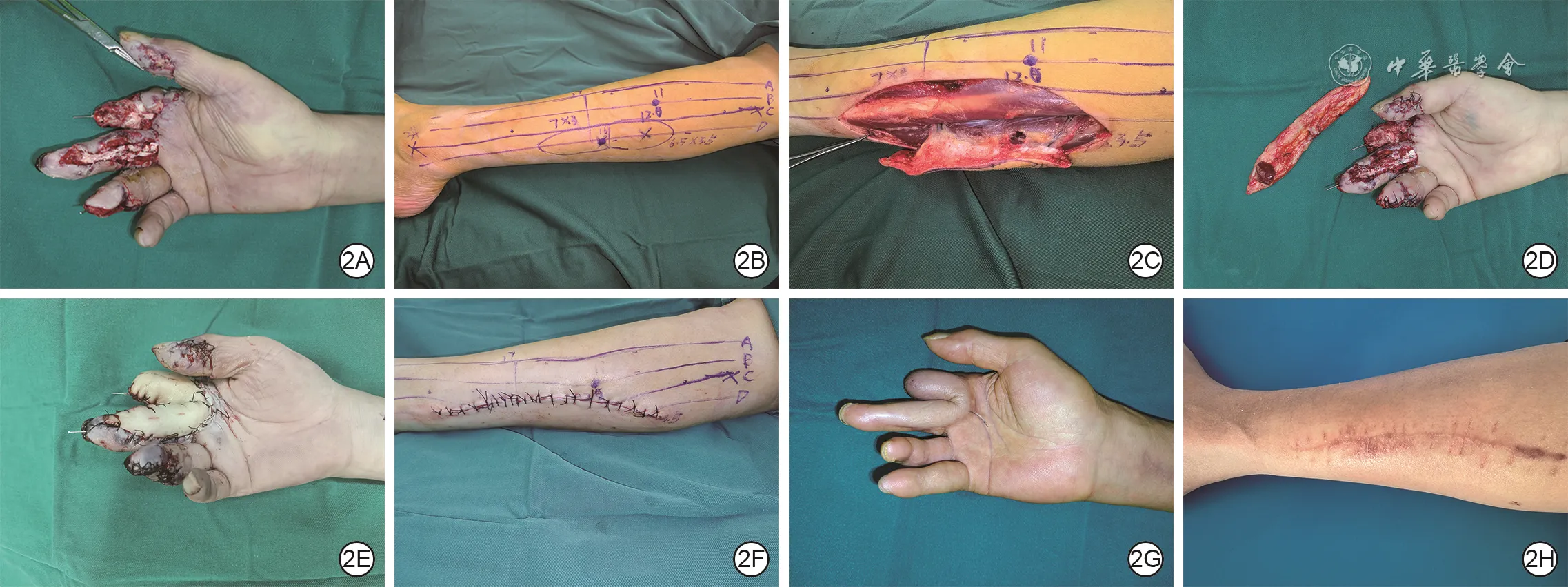 Operative sequence and nine-month follow-up of right-hand reconstruction with a peroneal artery perforator flap designed using the three-source and four-line method