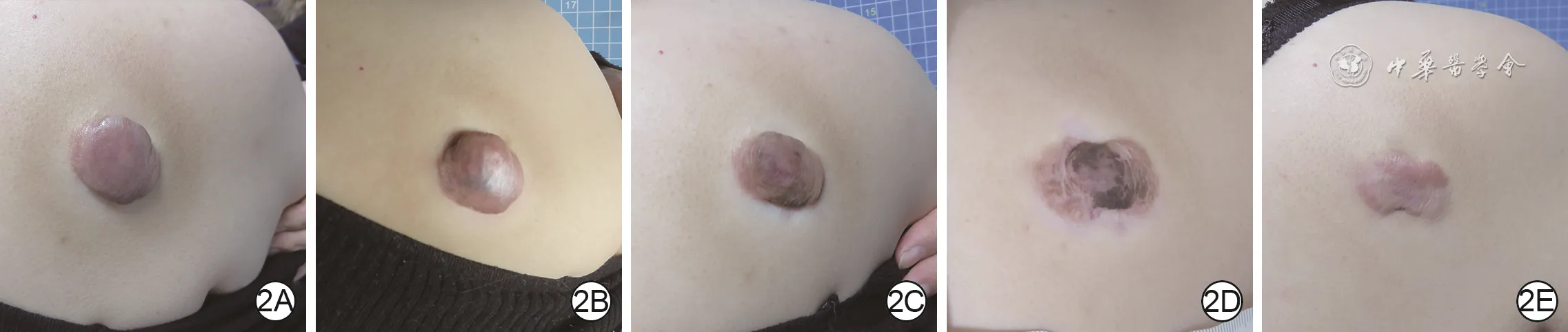 Shoulder-back keloid before and at one, two, seven, and ten months after triamcinolone injection treatment