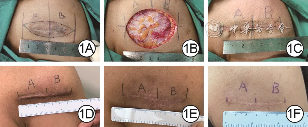 Preoperative, operative, and twelve-month follow-up comparison of external sutures versus no external sutures within the same incision after right shoulder scar excision