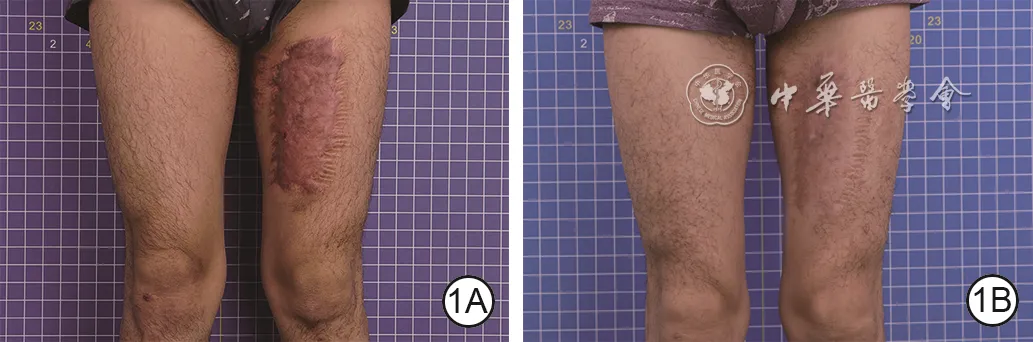 Left thigh hypertrophic scar before and nine months after pressure therapy combined with narrow-band intense pulsed light